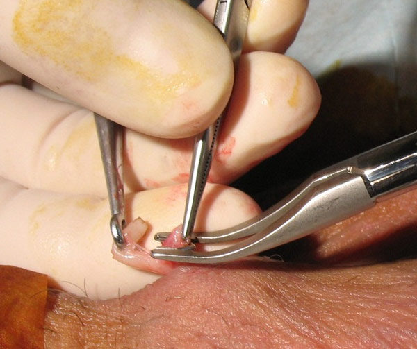 https://www.bestvasectomy.com/wp-content/uploads/photo-gallery/Open%20Ended%20Vasectomy/vasectomy-clip-application.jpg